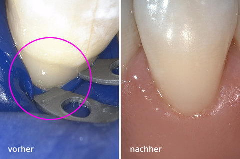 Zahnhalsdefekt Behandlung München