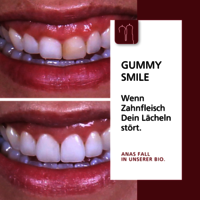 Gummy-Smile-Korrektur München