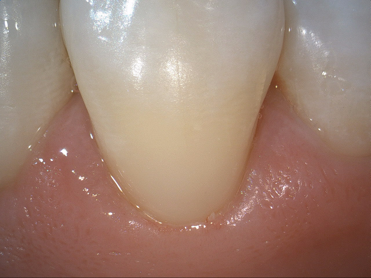 perfekte Zahnhalsfüllung nach Zahnhalsdefekt